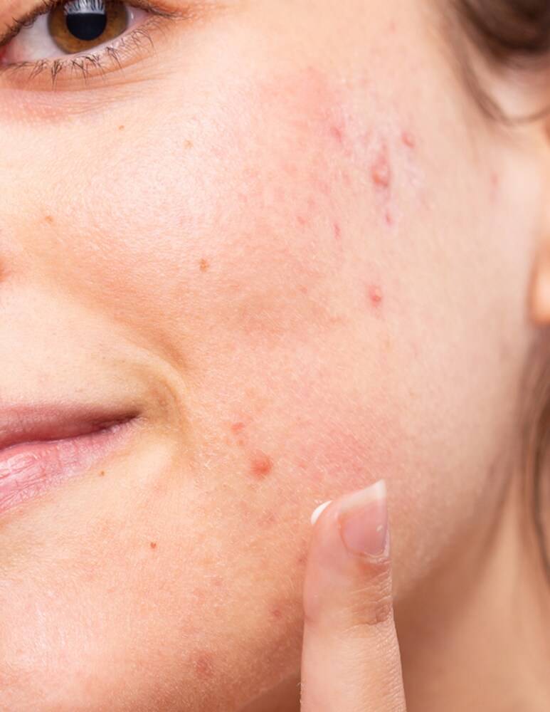 Freshly Cosmetics Azelaic Radiance Face Treatment
