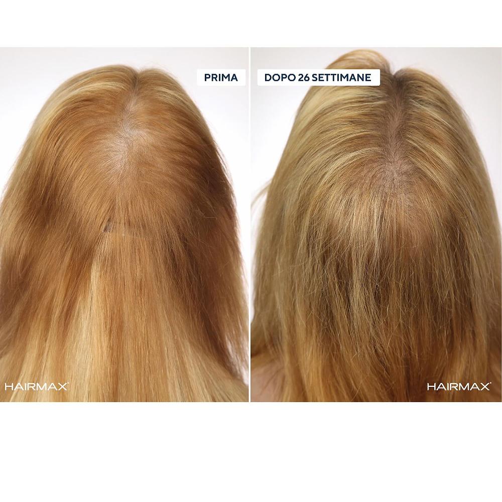 QVC HairMax LaserBand Dispositivo Laser Crescita CapellI