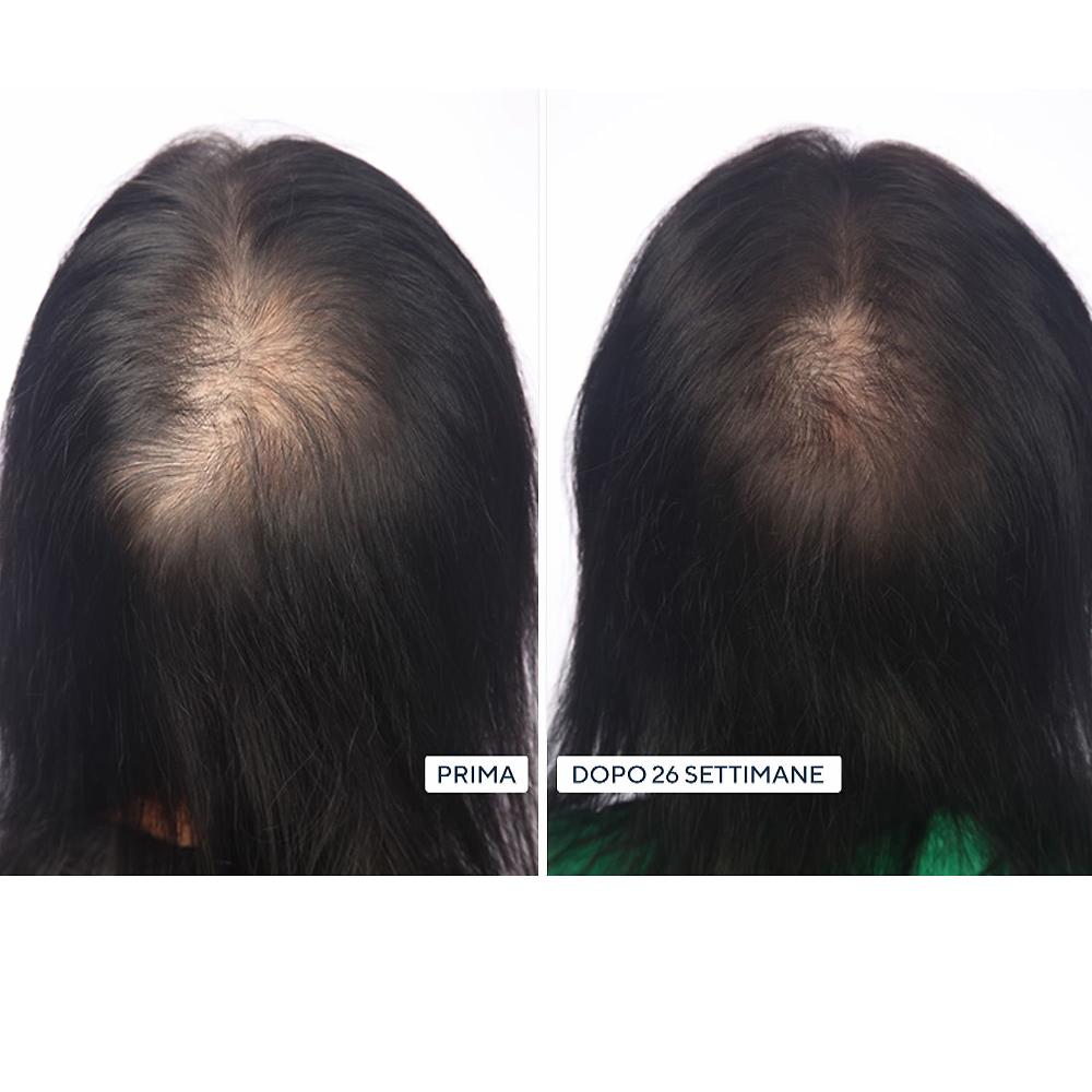 QVC HairMax LaserBand Dispositivo Laser Crescita CapellI