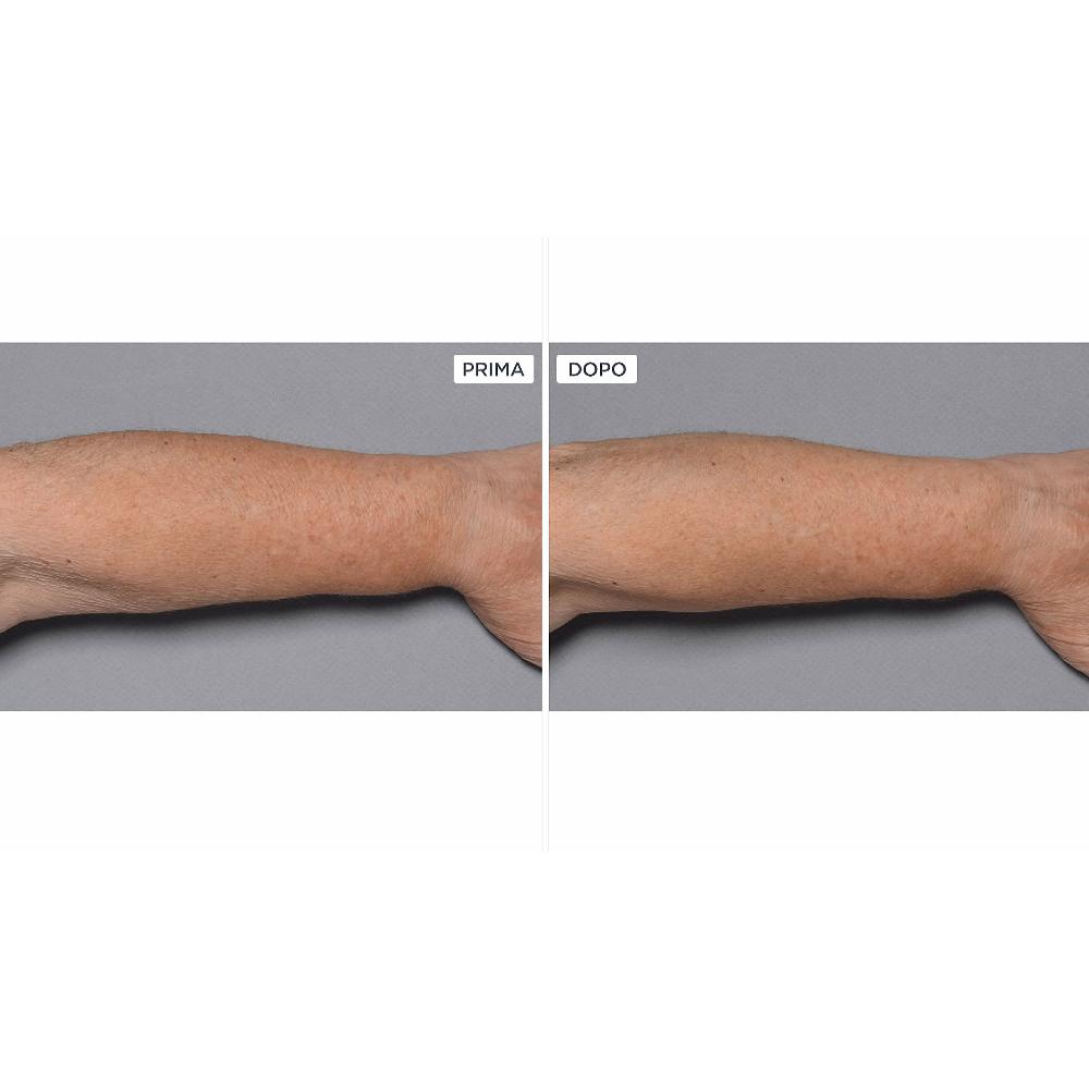 QVC Perricone MD Cold Plasma+Fragile Skin Corpo 2pz