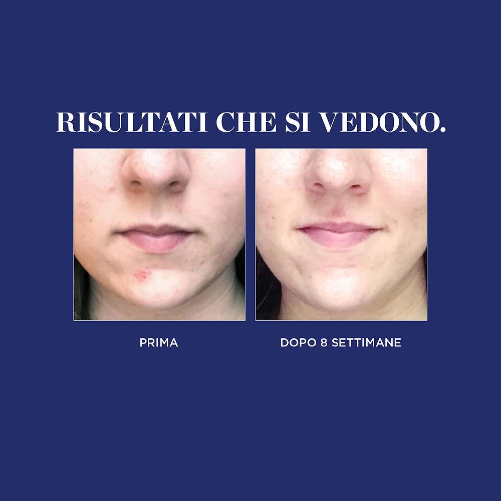 QVC Perricone MD Detergente No:Rince E Due Trattamenti Blemish Relief